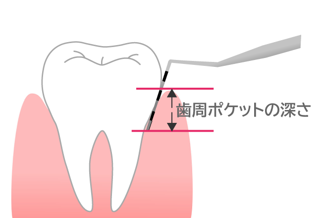 歯周ポケットの深さ